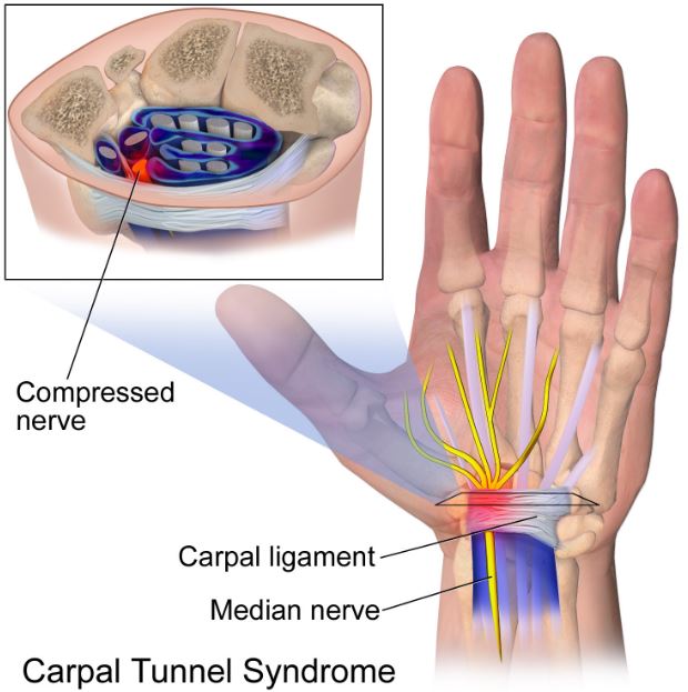 Carpal Tunnel Syndrome